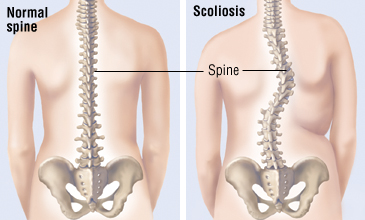 scoliosis - spine